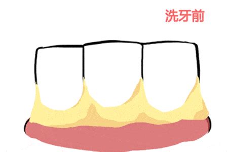 宫腔镜行诊刮术和刮宫一样吗