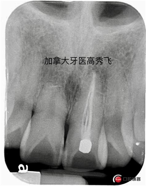 口腔溃疡可以做根管治疗吗