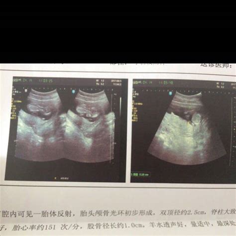 怀孕初期 b超图片