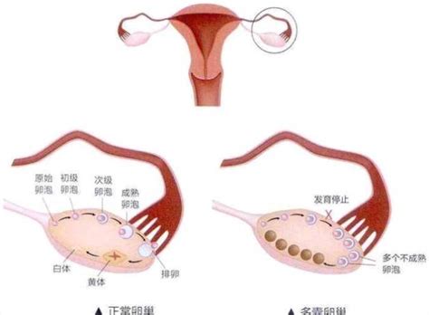 多囊好孕的方法有哪些