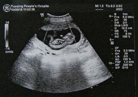 怀孕35周b超显示双侧肾盂分离