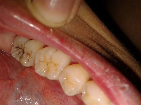 牙齿正上方中间有条深色的线``是什么啊?