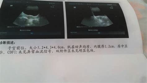 b超检查单cdfi是什么意思