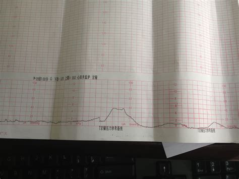 胎心监护线图解