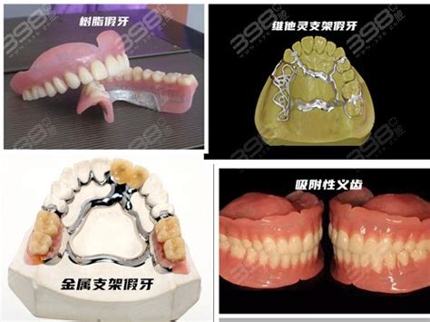 全口假牙的价目表