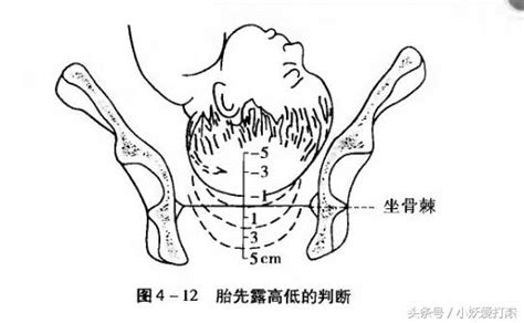 盆腔检查是检查什么