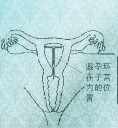 女人的无痛取环的过程