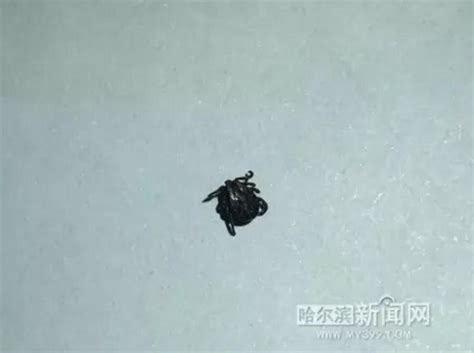蜱虫清理全过程