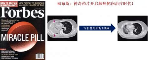 小孩癌症早期症状