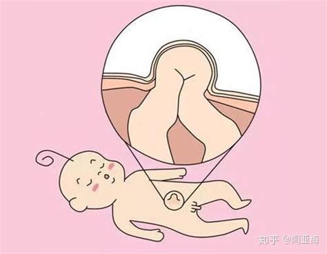 怀孕肚脐眼突出和不突出的区别