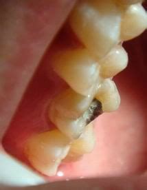 镶的假牙套里面的牙齿痛怎么办