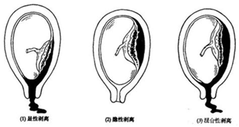 手剥胎盘是手伸进去吗