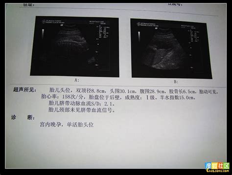 怀孕8周的b超单图片
