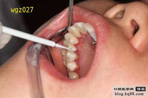 牙齿托槽粘接方法