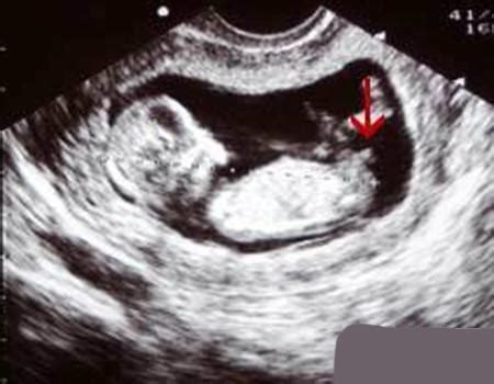 性别分化的胎儿期：怀孕9-12周