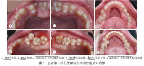 牙槽骨增生切除手术多少钱