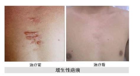 術后 疤痕增生怎么治療
