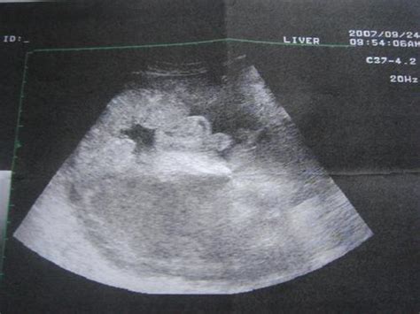孕妇妊娠线与胎儿性别图片