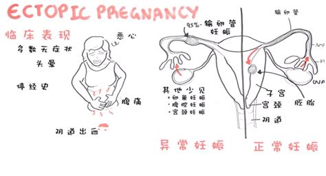 孕期胎儿异常的表现