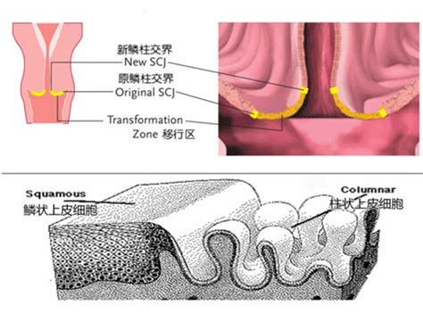 宫腔下段至宫颈内口间囊样回声