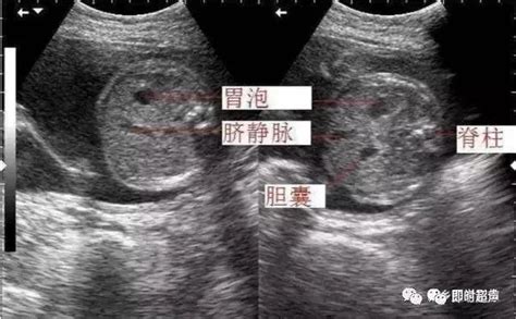 孕22周胎盘正常厚度