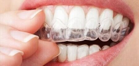 树脂假牙能戴几年