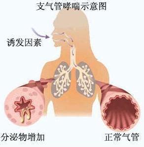 支气管哮喘不能吃什么