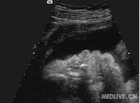 b超胎儿鼻后三角图片