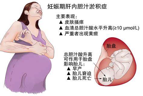 怀孕二胎还会有胆汁淤积症吗