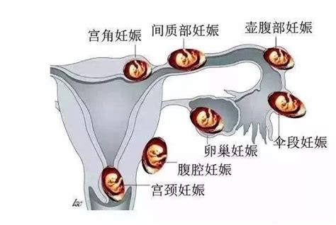输卵管粘连怎么会怀孕