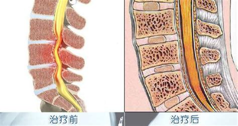按摩椅可以治療頸椎病嗎?