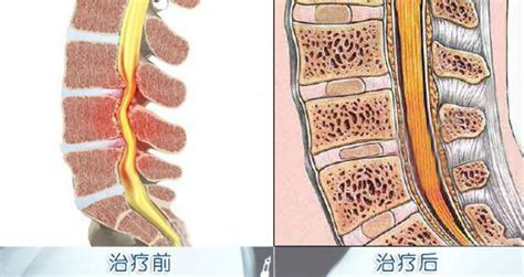 按摩椅可以治疗颈椎病吗?