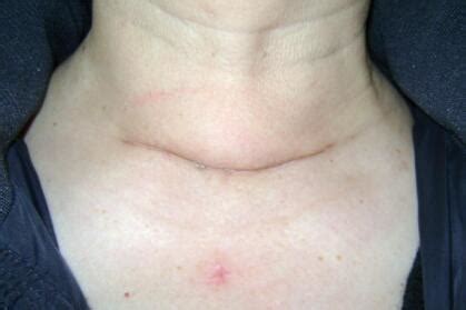 甲状腺结节状致密影是什么意思