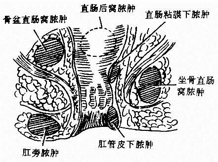 肛门褶皱处起了个疙瘩,医生怀疑是肛窦炎,让做b超,说如果有