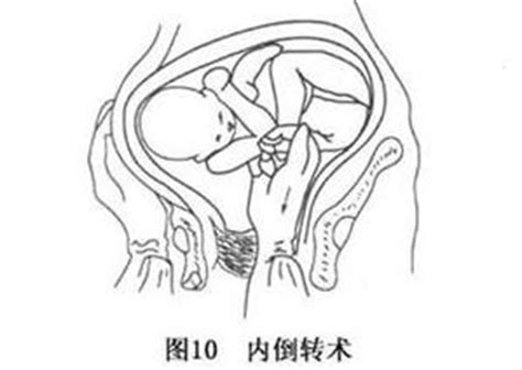 6个月胎儿臀位正常吗