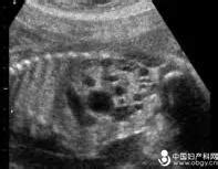 胎儿憋尿会误诊多囊肾吗