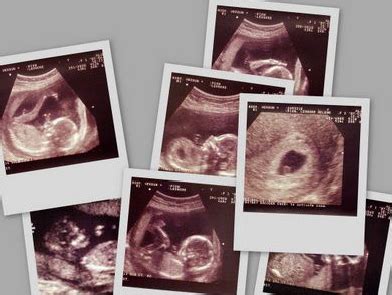 16周胎儿多普勒彩超影像报告