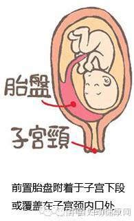 胎儿入盆的5大征兆
