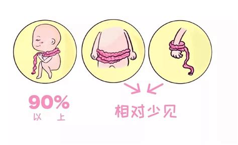 胎儿脐带绕颈会有危险吗