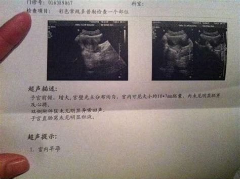 胎监胎心与b超胎心哪个准
