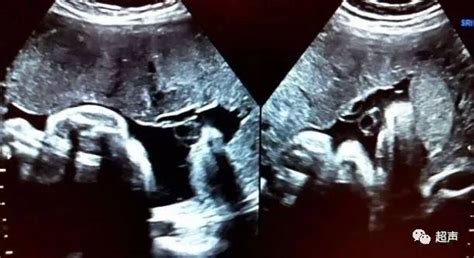 怀孕初期哪些指标可以看胎儿正常