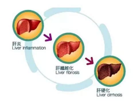 女子肝硬化吃一种草病情好转