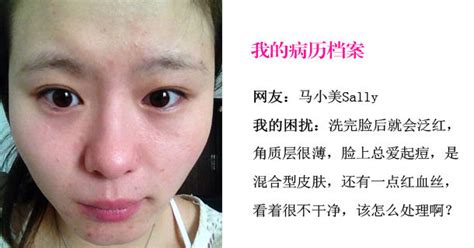 感冒好了脸上有红点多怎么办