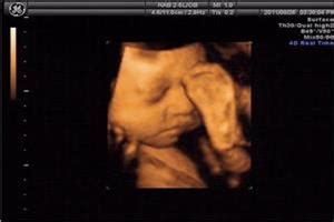 怀孕四周彩超能看见胚胎吗