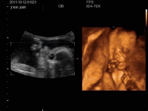 11周胎儿彩超图片