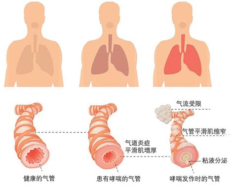 哮喘发作推拿