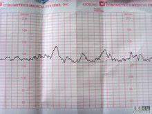 35周的胎心监护