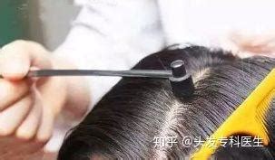 求梅花針治脫發詳情