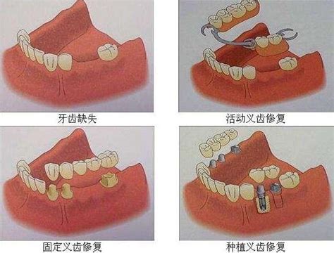 假牙分别有哪几种
