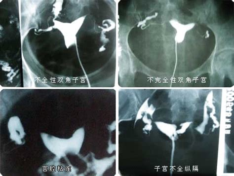 输卵管造影后当月能怀孕吗